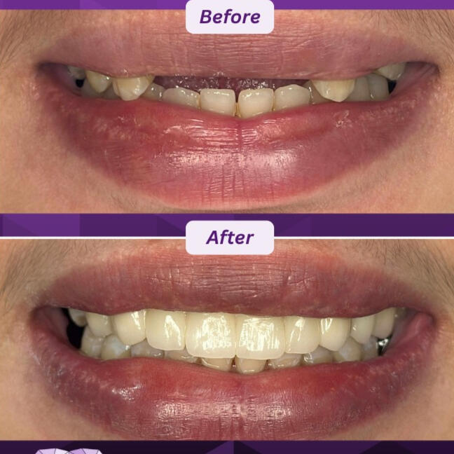Zirconia Bridge Zirconia Bridge transformation before and after at OGQ Dental Clinic Pateros