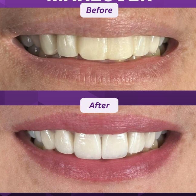 Porcelain Veneers Porcelain veneers transformation before and after at OGQ Dental Clinic Pateros