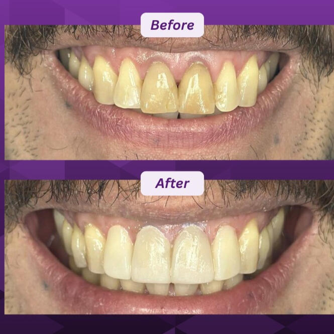 Direct Composite Direct Composite transformation before and after at OGQ Dental Clinic Pateros